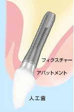 インプラント治療とは？