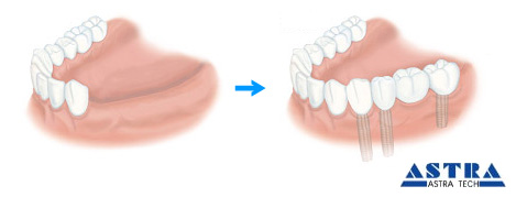 信頼性の高いインプラントシステム